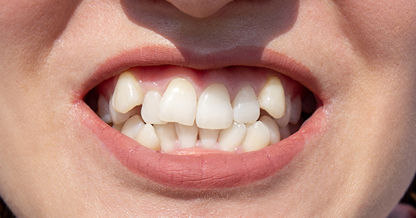 How to fix gaps between teeth without braces